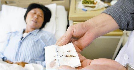通過手術取出的針。　　商報記者 