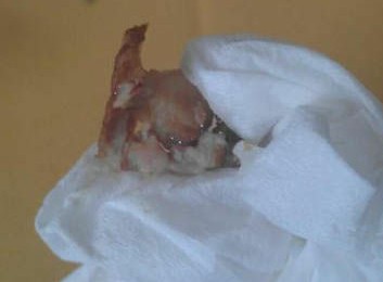 吃出水銀狀物體的豬大腸。