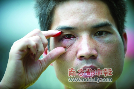 皮某身上多處被打傷。 皮某身上多處被打傷。