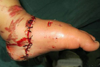 電瓶車絞斷女童左腳 醫生呼吁強制安裝防護網 電瓶車絞斷女童左腳 醫生呼吁強制安裝防護網