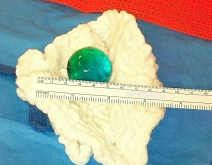 女嬰吞下玩具球吸水膨脹 腸子被堵險(xiǎn)喪命 女嬰吞下玩具球吸水膨脹 腸子被堵險(xiǎn)喪命