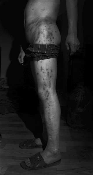 10月4日,湖北智障人士吳發(fā)兵腰部及腿部傷痕累累。他稱,8月8日,他被騙到洗車行工作,多次遭領(lǐng)班毆打。