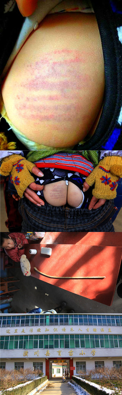 學生挨打的痕跡至今清晰可見