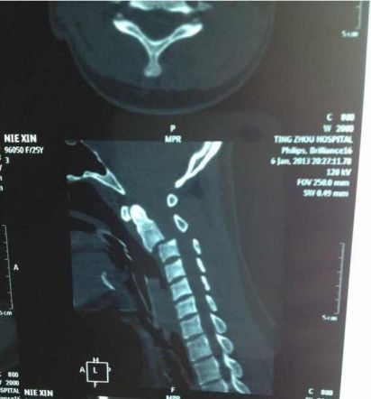 女演員聶鑫遇車禍?zhǔn)苤貍殖芍参锶?隨時有可能死亡